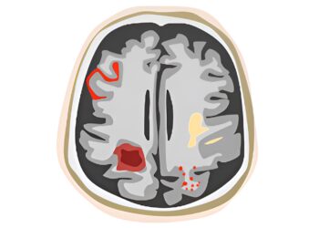 La FDA autoriza Inteligencia Artificial para monitorear complicaciones en los tratamientos de Alzheimer