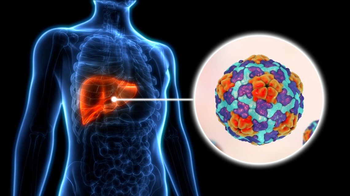 Más de 2,000 personas superan la hepatitis C en Puerto Rico
