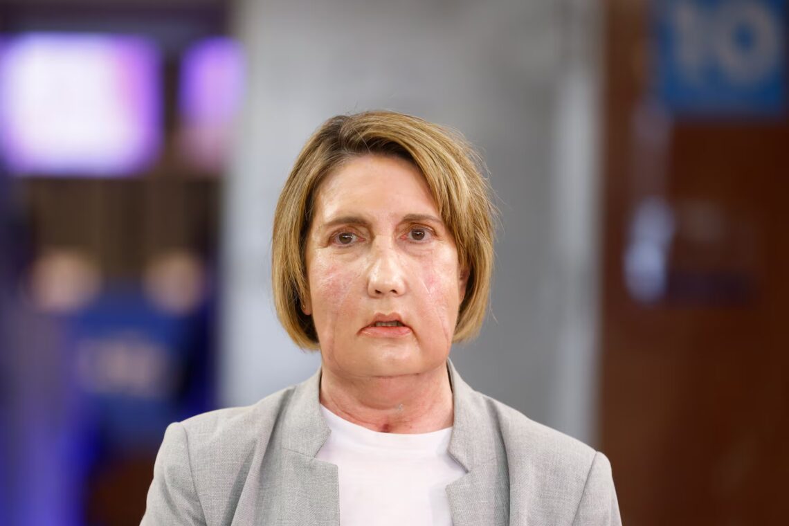 Trasplante facial pionero abre nuevas posibilidades en medicina reconstructiva